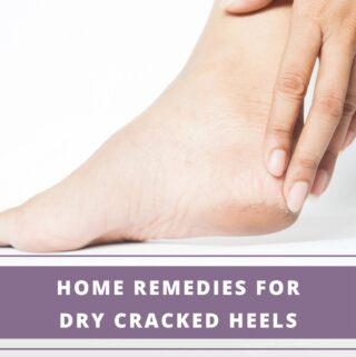 home remedies to treat cracked heels