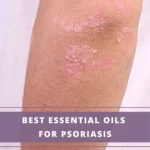 person's elbow with psoriasis - how to use essential oils for psoriasis